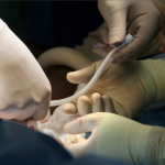 Искусственный кровеносный сосуд пересажен пациенту