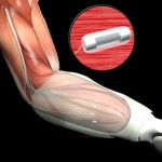 Протезные интерфейсы от DARPA дает новую надежду людям с ампутированными конечностями 