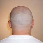 Новое лекарство против облысения: рост волос при помощи стволовых клеток