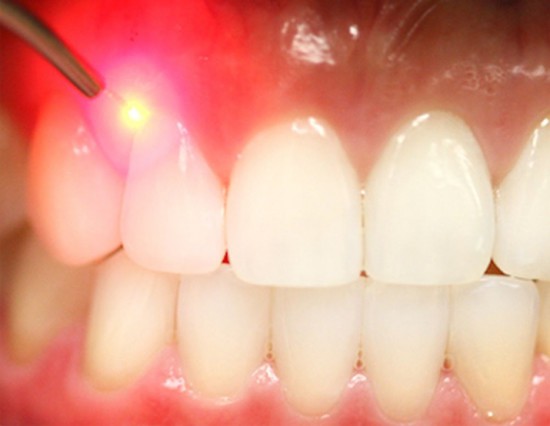 dental-laser